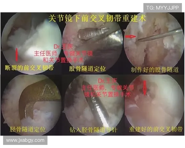 罗德里戈2023年十字韧带损伤保守治疗